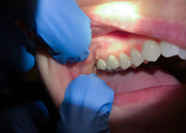 Best Emergency Wisdom Teeth Removal in White Bear Lake, MN